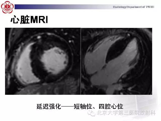 【病例】肥厚性心肌病1例MR影像表现