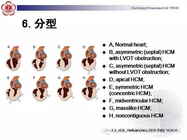 【病例】肥厚性心肌病1例MR影像表现