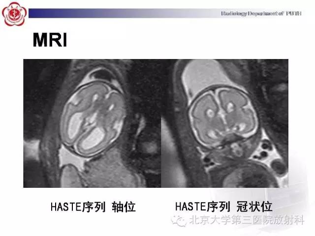 【病例】胎儿胼胝体发育不全1例MR