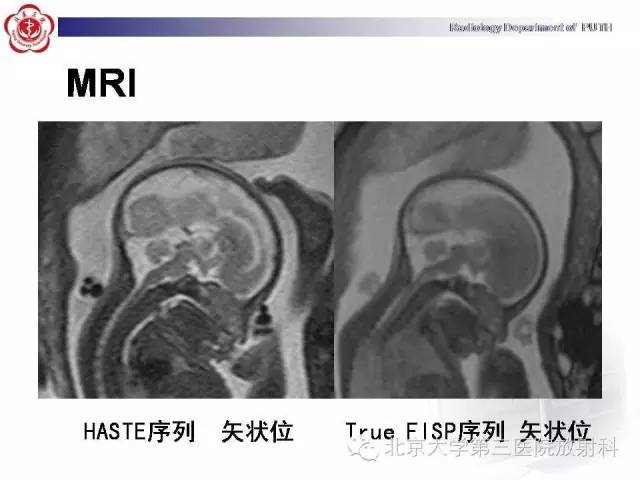 【病例】胎儿胼胝体发育不全1例MR