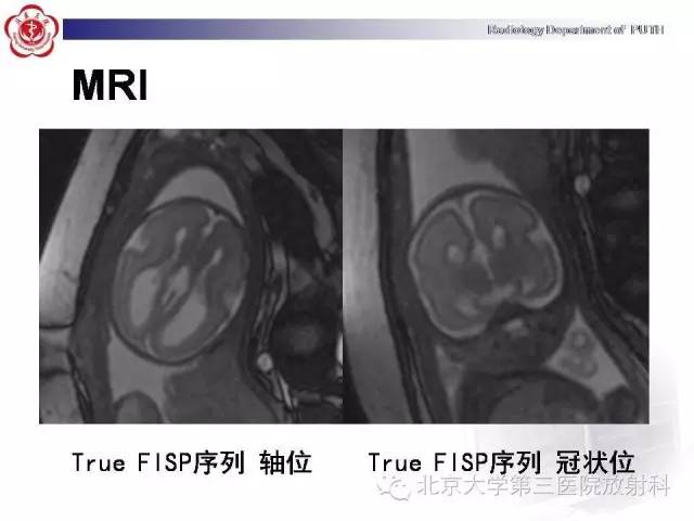 【病例】胎儿胼胝体发育不全1例MR