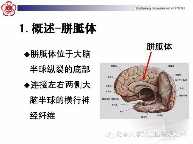 【病例】胎儿胼胝体发育不全1例MR