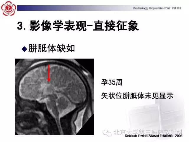 【病例】胎儿胼胝体发育不全1例MR