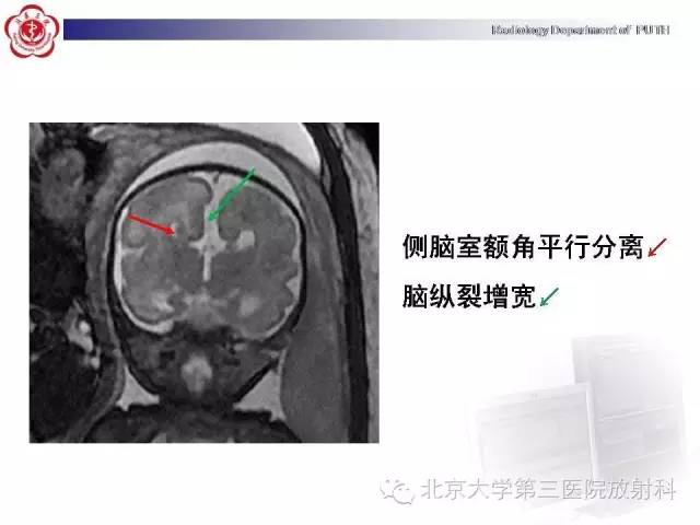 【病例】胎儿胼胝体发育不全1例MR