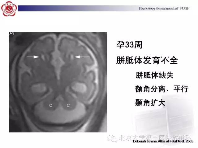 【病例】胎儿胼胝体发育不全1例MR