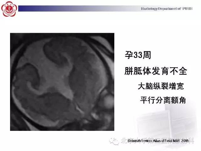 【病例】胎儿胼胝体发育不全1例MR