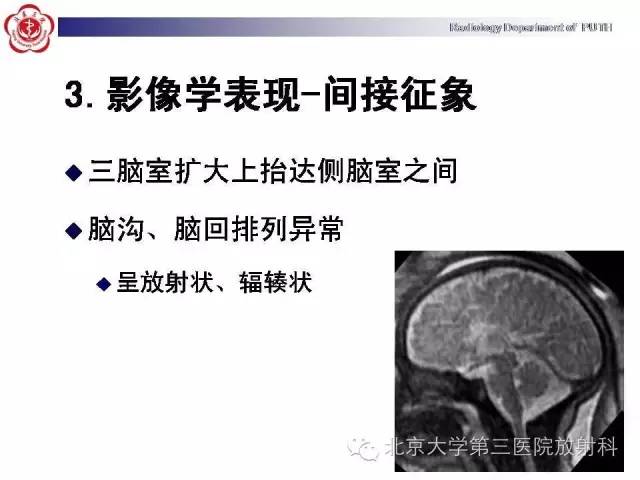 【病例】胎儿胼胝体发育不全1例MR