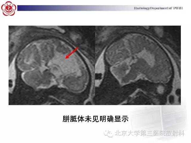【病例】胎儿胼胝体发育不全1例MR