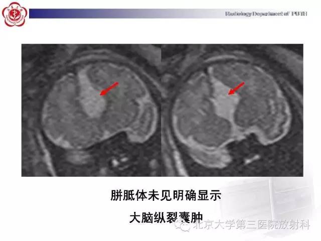 【病例】胎儿胼胝体发育不全1例MR