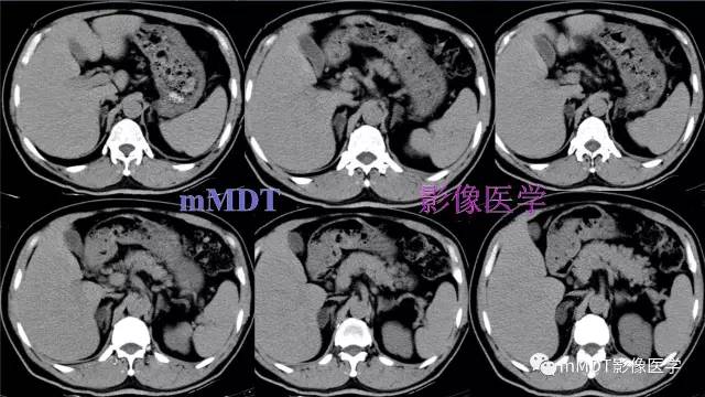 【PPT】双侧肾上腺占位性病变的影像诊断解析