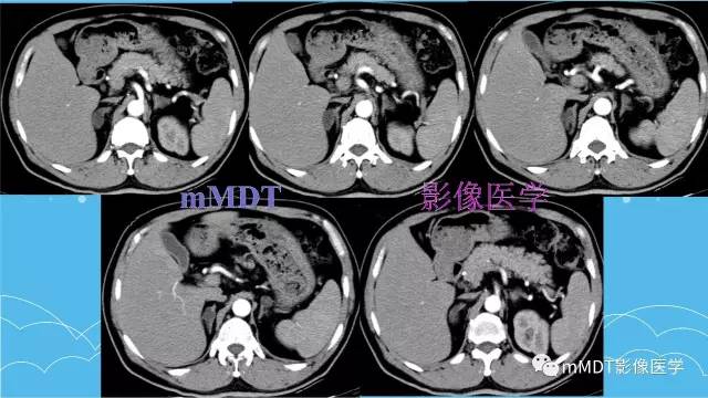 【PPT】双侧肾上腺占位性病变的影像诊断解析