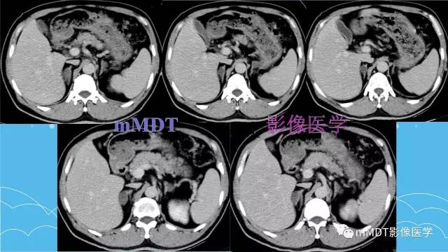 【PPT】双侧肾上腺占位性病变的影像诊断解析