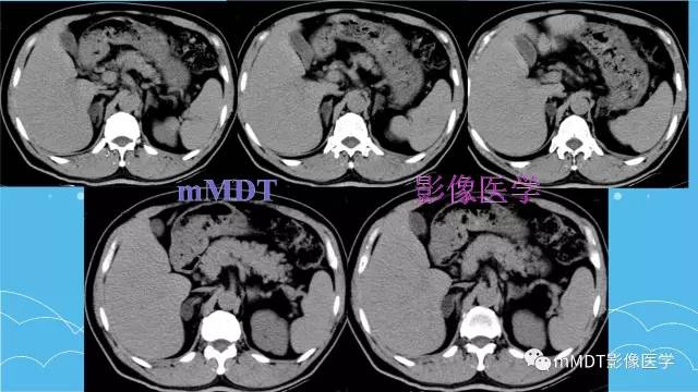 【PPT】双侧肾上腺占位性病变的影像诊断解析