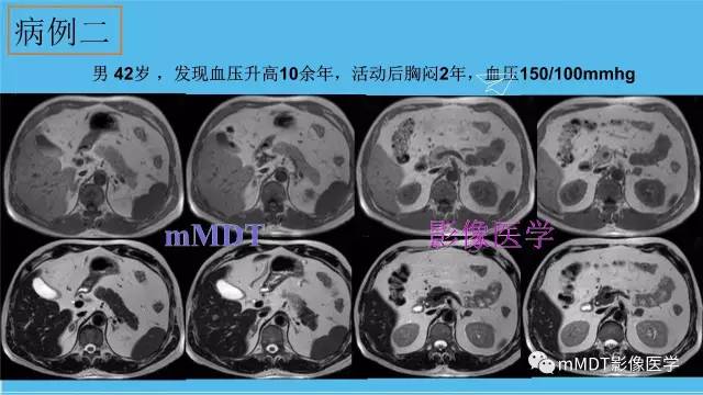 【PPT】双侧肾上腺占位性病变的影像诊断解析