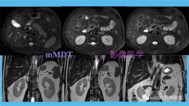 【PPT】双侧肾上腺占位性病变的影像诊断解析
