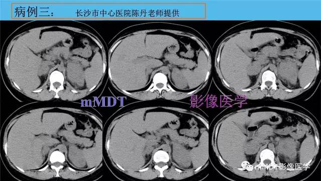 【PPT】双侧肾上腺占位性病变的影像诊断解析