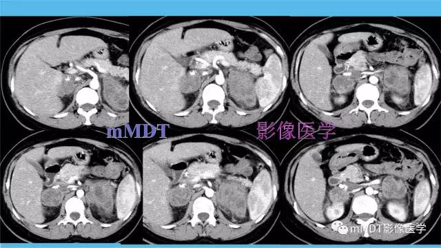 【PPT】双侧肾上腺占位性病变的影像诊断解析