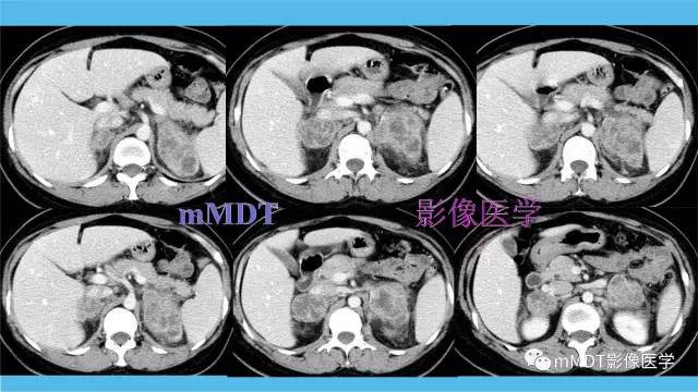 【PPT】双侧肾上腺占位性病变的影像诊断解析