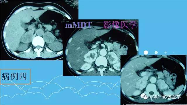 【PPT】双侧肾上腺占位性病变的影像诊断解析