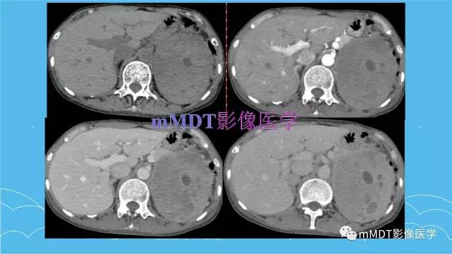 【PPT】双侧肾上腺占位性病变的影像诊断解析