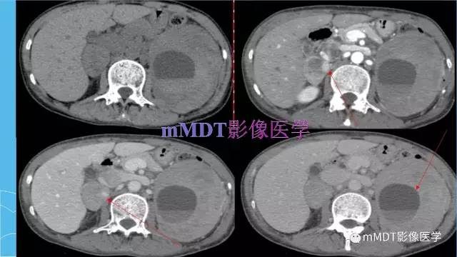 【PPT】双侧肾上腺占位性病变的影像诊断解析