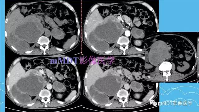 【PPT】双侧肾上腺占位性病变的影像诊断解析