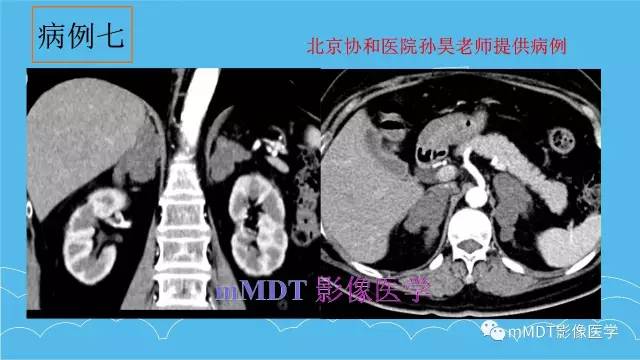 【PPT】双侧肾上腺占位性病变的影像诊断解析