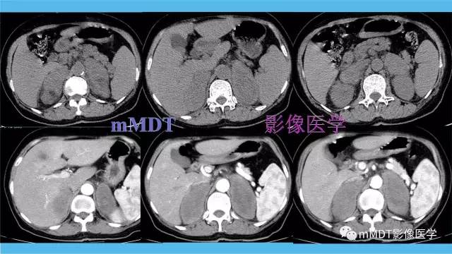 【PPT】双侧肾上腺占位性病变的影像诊断解析