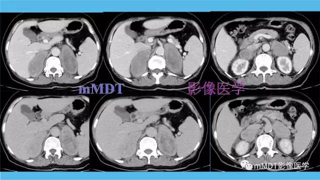 【PPT】双侧肾上腺占位性病变的影像诊断解析