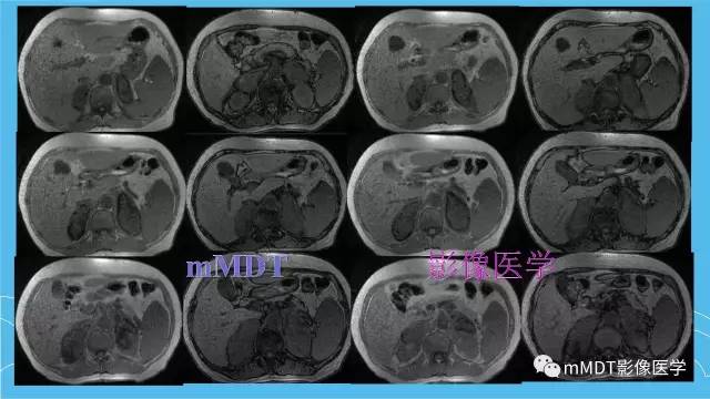 【PPT】双侧肾上腺占位性病变的影像诊断解析