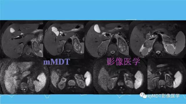 【PPT】双侧肾上腺占位性病变的影像诊断解析