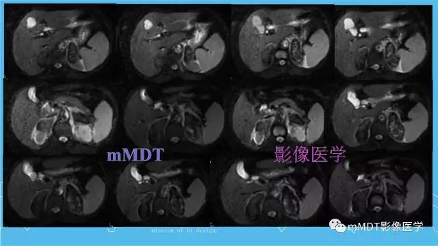 【PPT】双侧肾上腺占位性病变的影像诊断解析