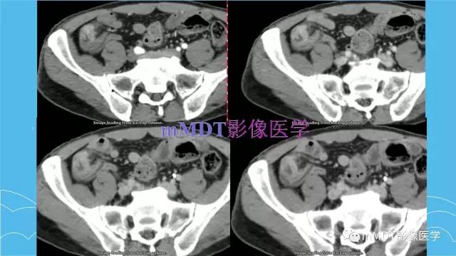 【PPT】双侧肾上腺占位性病变的影像诊断解析
