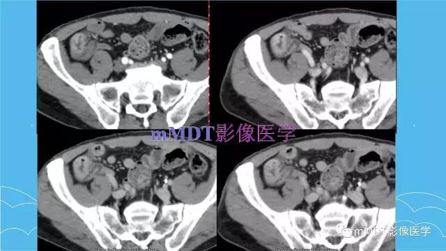 【PPT】双侧肾上腺占位性病变的影像诊断解析