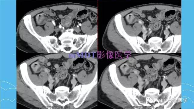 【PPT】双侧肾上腺占位性病变的影像诊断解析