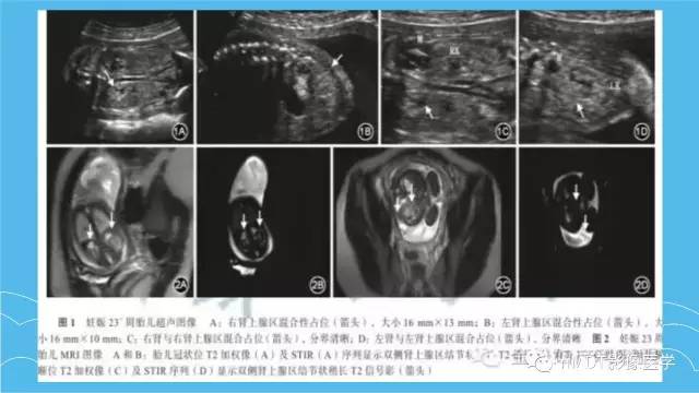 【PPT】双侧肾上腺占位性病变的影像诊断解析