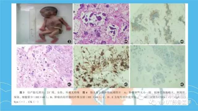 【PPT】双侧肾上腺占位性病变的影像诊断解析