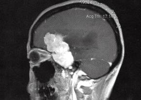【病例】右蝶骨嵴非典型脑膜瘤1例MR 【病例】右蝶骨嵴非典型脑膜瘤1例MR