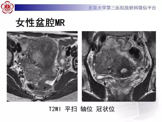 【病例】子宫绒毛叶状分割性平滑肌瘤1例MR