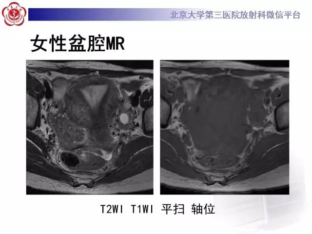 【病例】子宫绒毛叶状分割性平滑肌瘤1例MR