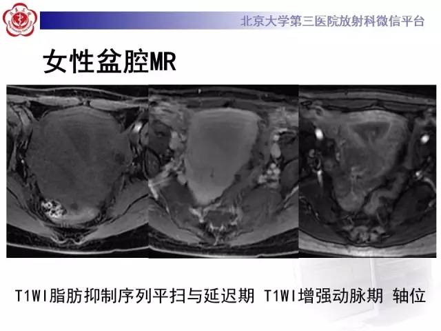 【病例】子宫绒毛叶状分割性平滑肌瘤1例MR