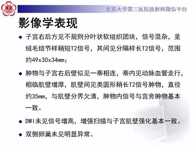 【病例】子宫绒毛叶状分割性平滑肌瘤1例MR