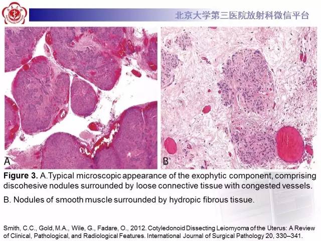 【病例】子宫绒毛叶状分割性平滑肌瘤1例MR
