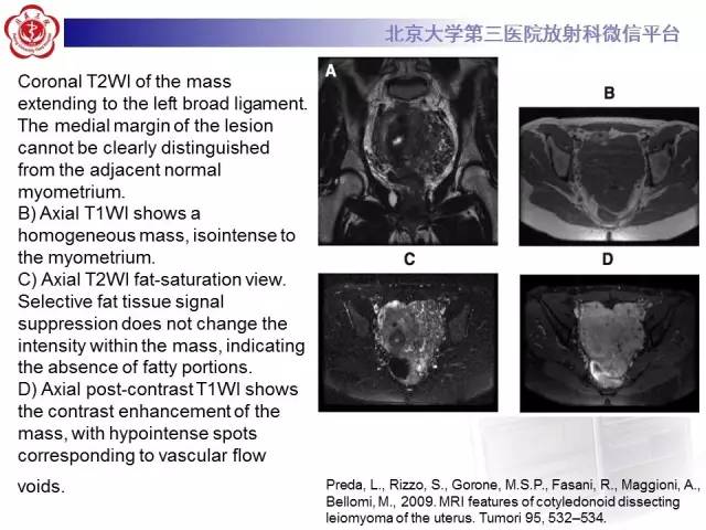 【病例】子宫绒毛叶状分割性平滑肌瘤1例MR