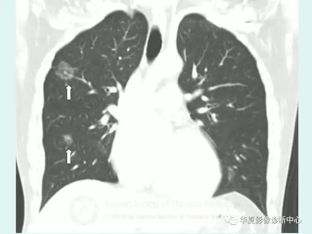 【病例】侵袭性肺曲霉菌病1例CT