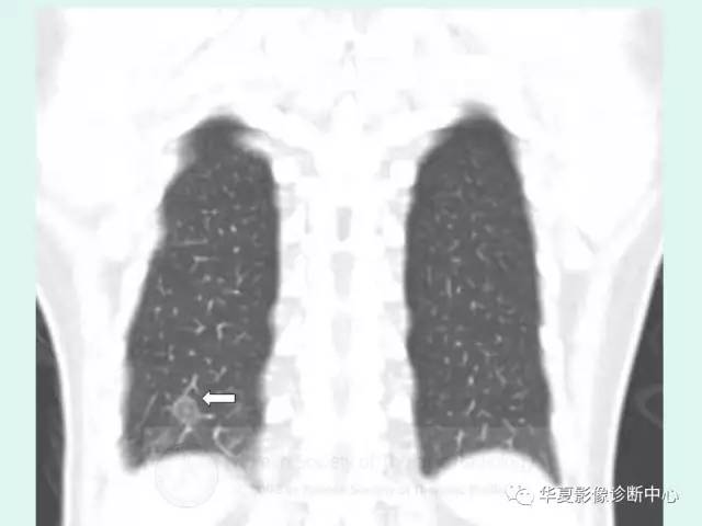 【病例】侵袭性肺曲霉菌病1例CT