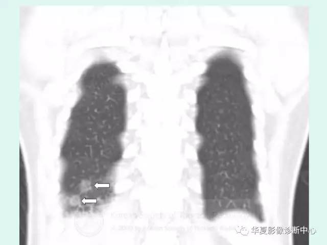 【病例】侵袭性肺曲霉菌病1例CT