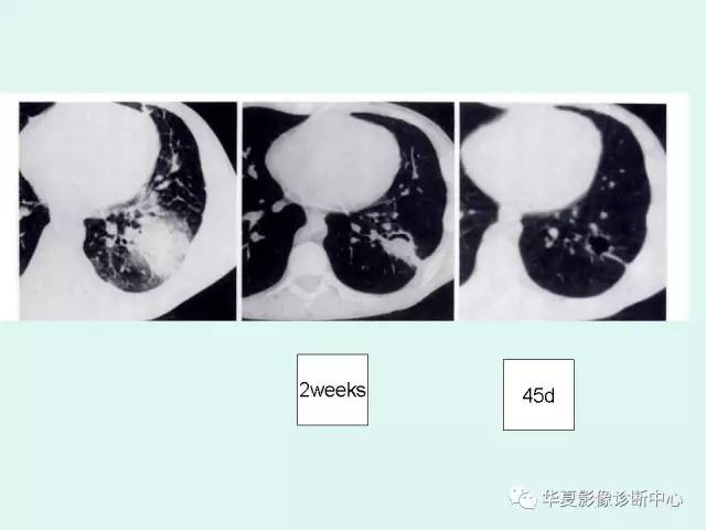 【病例】侵袭性肺曲霉菌病1例CT