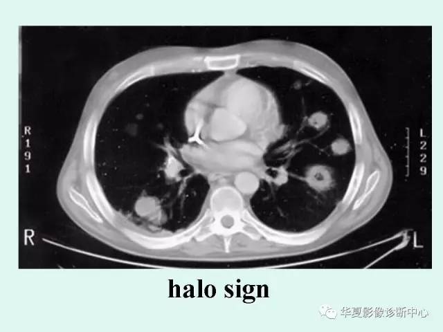 【病例】侵袭性肺曲霉菌病1例CT