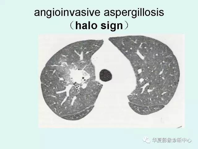 【病例】侵袭性肺曲霉菌病1例CT